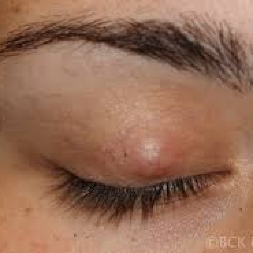 Sty Face Styes and Skin Tags: Goldberg Centre