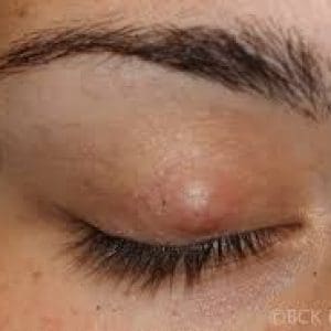 Chalazion surgery Toronto